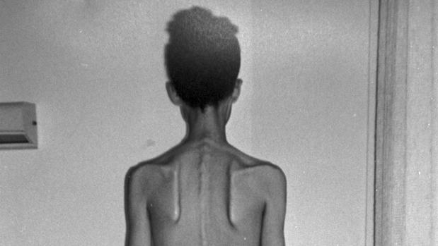 anorexia-bulimia-abc-k3YH--620x349@abc.jpg